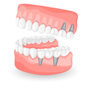 500 x 500px All on four Implant