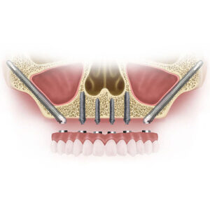 500 x 500px Zygoma Implants